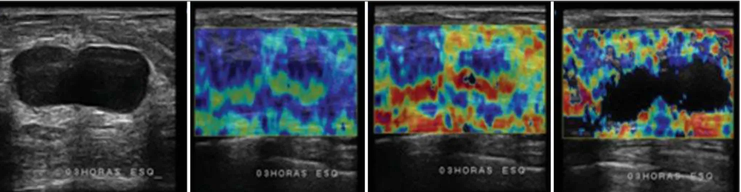 Figure 5. A complicated cyst at the conventional mode (left image) utilizing compression (second image), post-decompression elastography (third image), and after inappropriate compression (right image)