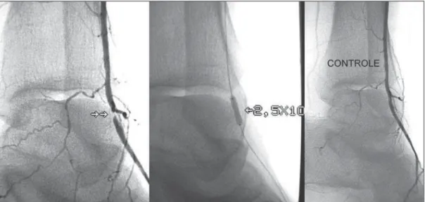 Figure 1. Angioplasty of the dorsalis pedis artery  utiliz-ing 0.014″ guide wire and 2.5 × 10 balloon.