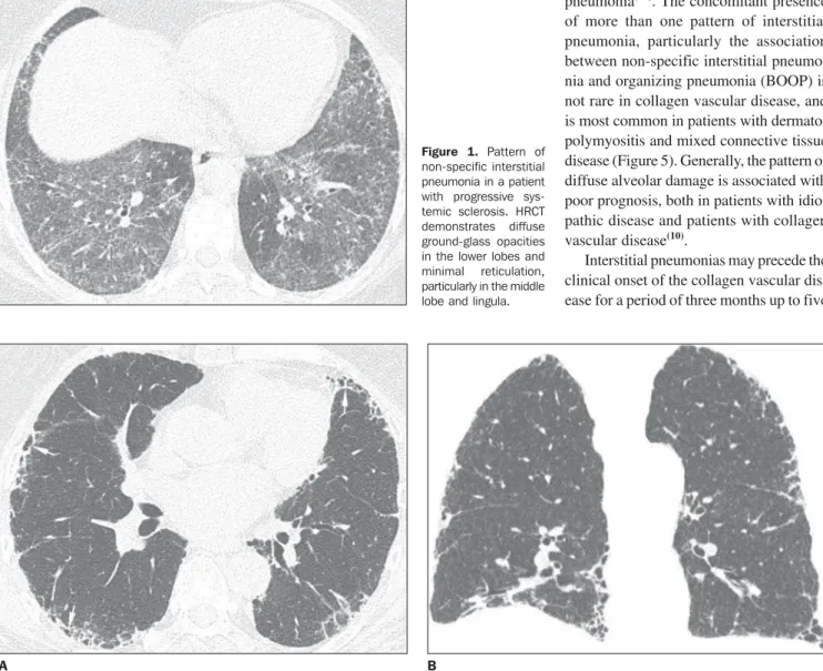 Figure 1. Pattern of non-specific interstitial pneumonia in a patient with progressive  sys-temic sclerosis