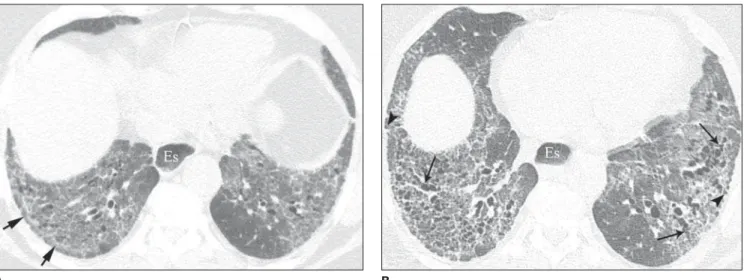 Figure 4. High-resolution CT follow-up of non-specific interstitial pneumonia in a patient with progressive systemic sclerosis receiving corticosteroid therapy.