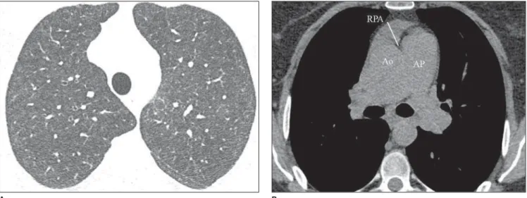Figure 10. Diffuse pul- pul-monary hemorrhage in a patient with systemic lupus erythematosus.