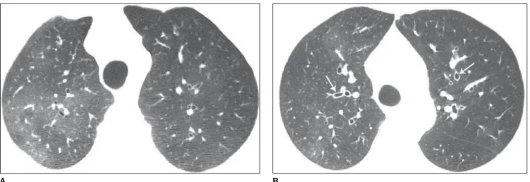 Figure 13. Airway abnormalities in a patient with rheumatoid arthritis. HRCT images (A, B) demonstrate dilated bronchi (arrows on B) and signs of small airway involvement (bronchiolitis obliterans) characterized by areas of decreased attenuation and vascul