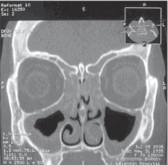 Figure 1. Coronal CT scan of paranasal sinuses showing  poly-poidal disease in the ethmoids, mucosal thickening in the antra, and asymmetry of the inferior turbinates