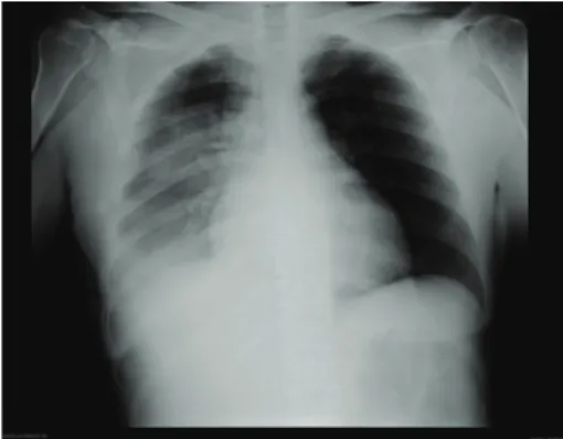Figure 1: Admission chest radiograph showing patchy peri- peri-bronchial and right lower lobe consolidation.