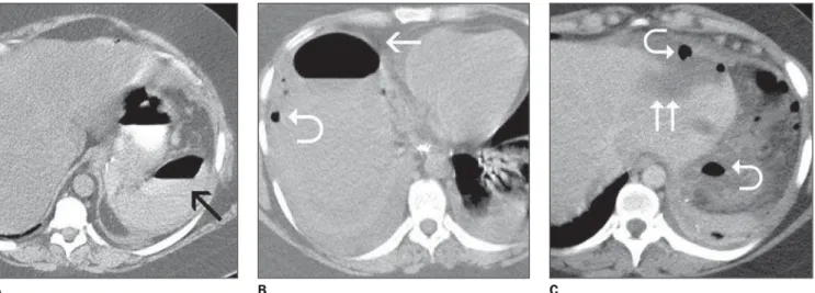 Figure 2. Aspects of leaks on CT. A: Perisplenic collection with extraluminal oral contrast material and fluid level (arrow)