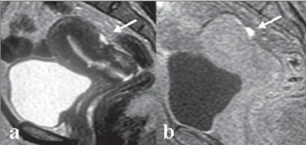 Figure 2. Axial, T2-weighted image (a), T1-weighted image with fat suppression (b) and T1-weighted image (d) show adhesion in the posterior cul-de-sac confirmed by laparoscopy (c)