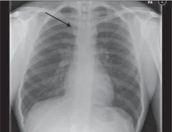 Figure 1. Chest radiograph showing mild mediastinal widening (arrow).
