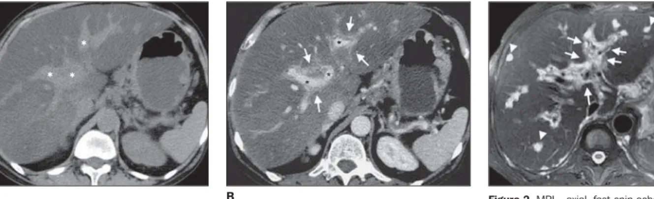 Figure 2. MRI – axial, fast-spin echo, T2-weighted image better demonstrates the tissue  character-ized by hyperintense signal surrounding the  peri-portal planes (arrows), and manifesting as  nod-ules in some regions (arrowheads).