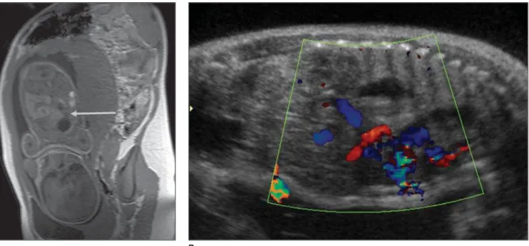 Figure 1. A: Coronal T1-weighted MR image demonstrating slightly hyperintense liver herniated into the left hemithorax (arrow)