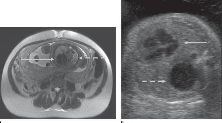 Figure 3. A: Axial, T2-weighted MRI demonstrating herniation of small bowel loops (dashed arrow) and right mediastinal shift (continuous arrow).