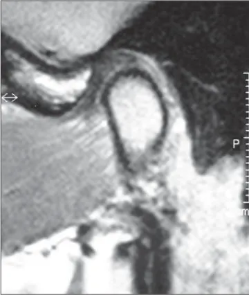 Figure 2. MRI sagittal image of closed mouth demonstrating anterior disk displacement.