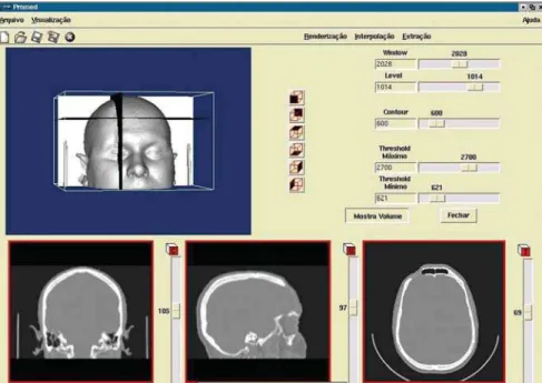 Figure 1. Visualization of 3D image, and coronal, sagittal and axial section planes, before segmentation.