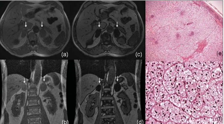 Figure 1. MRI axial T1-weighted phase-GRE (a) and coronal (b) sequences demonstrate bilateral adrenal lesion (arrows)