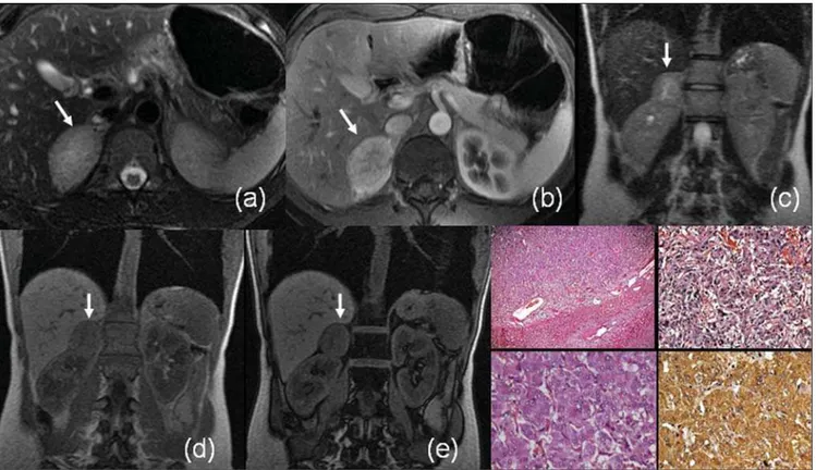 Figure 4. MRI axial, FSE T2-weighted (a), axial, contrast-enhanced GRE, T1-weighted (b), coronal SS-FSE T2-weighted (c), coronal in-phase-GRE T1-weighted (d) and out-of-phase GRE T1-weighted sequences (e) demonstrate a pheochromocytoma (arrows)