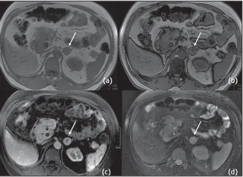 Figure 8. Contrast-enhanced MRI axial T1-weighted images demonstrate heterogeneous contras agent uptake in right adrenal metastasis (arrow on b) of hepatocelullar carcinoma (open arrow on a).
