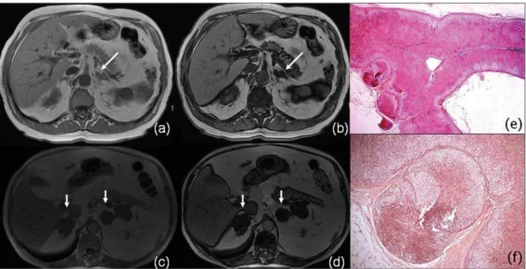 Figure 10. MRI axial in-phase(a) and out-of-phase (b) GRE T1-weigthed images demonstrate smooth thickening of left adrenal gland (arrow), with signal intensity loss on out-of-phase sequence