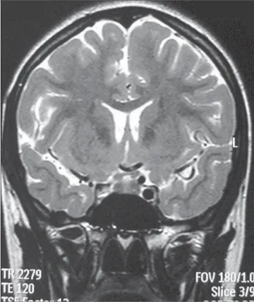 Figure 1. Initial coronal MRI turbo spin-echo T2-weighted sequence showing absence of flow void in the right ICA.