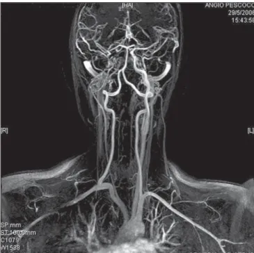 Figure 4. Cervical vessels MRI angiography confirming the right ICA absence.