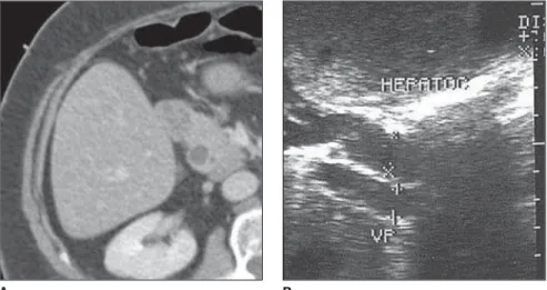 Figure 2. A,B,C,D: Upper abdominal magnetic resonance cholangiography.