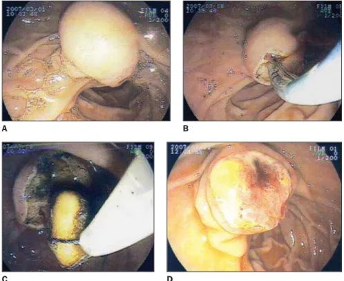 Figure 1.  A: Contrast-enhanced ab- ab-dominal computed tomography B: Upper abdominal ultrasonography
