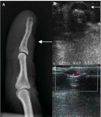 Figure 1. Case 8. Female, 47-year-old patient. Plain radiograph – lateral view (A):