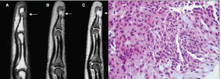Figure 3. Case 6. Female, 32-year-old patient. Sagittal MRI, T1-weighted sequence (A) and T1-weighted with fat-saturation, pre- (B) and post-contrast injec- injec-tion (C): small nodule with hypointense signal on T1-weighted sequence, hyperintense signal o