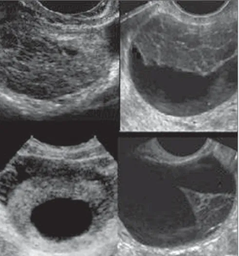 Figure 9. Sonographic images demonstrating four different echographic findings that can be observed in the evaluation of hemorrhagic ovarian cysts