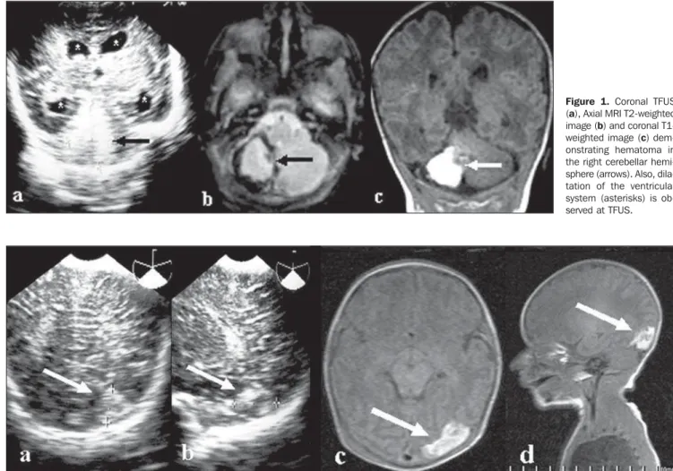 Figure 1. Coronal TFUS (a), Axial MRI T2-weighted image (b) and coronal  T1-weighted image (c)  dem-onstrating hematoma in the right cerebellar  hemi-sphere (arrows)