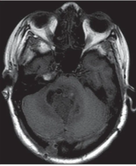 Figure 1. Axial MRI, T1-weighted sequence dem- dem-onstrating a hypointense mass located in the  pos-terior fossa, obliterating the IV ventricle, with foci of marked hyposignal possibly corresponding to air/