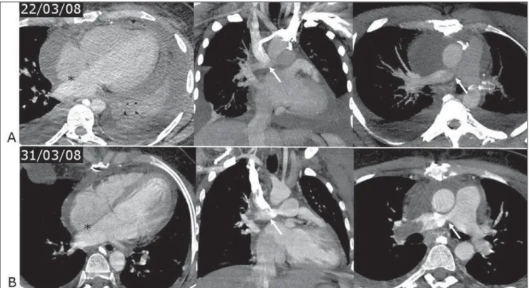 Figure 3. A: Computed tomography angiography demonstrating bilateral pleural effusion, with bibasal compressive atelectasis and pericardial effusion