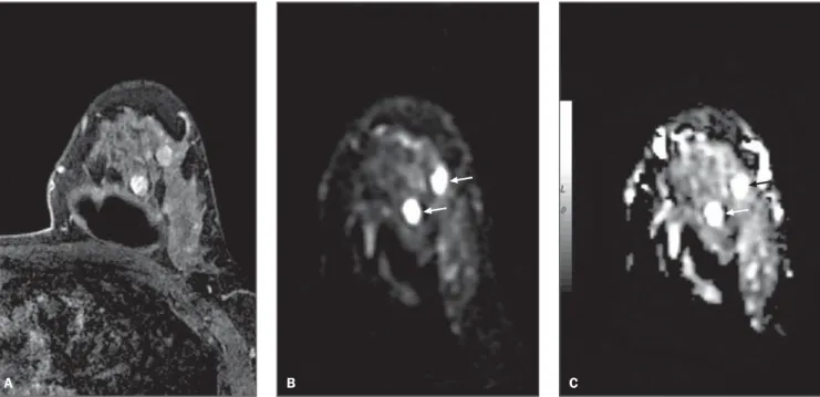 Figure 1. Female, 43-year-old patient presenting fibroadenomas in the left breast. Delayed phase contrast-enhanced 3D gradient, T1-weighted sequence with fat-suppression in the axial plane (A), diffusion-weighted sequence (b 500 s/mm 2 ) in the axial plane