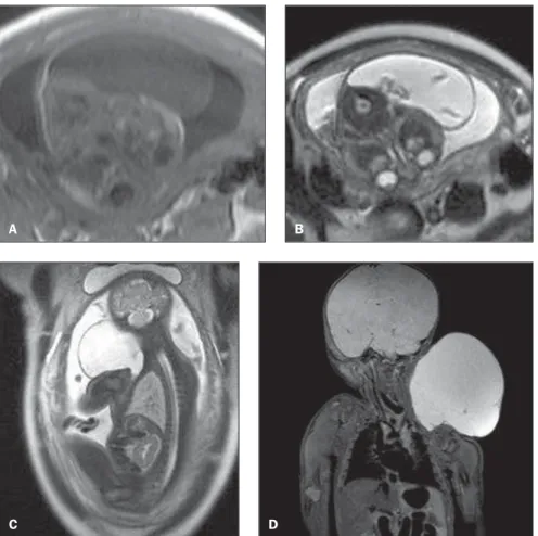 Figure 3. On A, image of the newborn 3 imme- imme-diately before the surgery, demonstrating  volumi-nous cystic hygroma at left