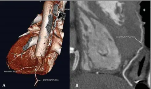 Figure 6. Axial images and 3D reconstruction of coronary CT angiography showing LITA (straight arrows) with sequential anastomosis (curved arrows) in diagonal branch and in the anterior descending artery.