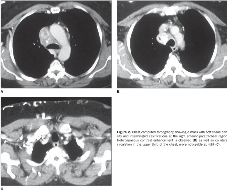 Figure 2. Chest computed tomography showing a mass with soft tissue den- den-sity and intermingled calcifications at the right anterior paratracheal region.