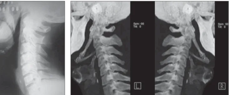 Figura 3. Tomografia computadorizada da coluna cervical, com reformatação 3D.