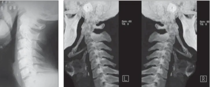 Figure 3. Computed tomography image with 3D reconstruction of the cervical spine.