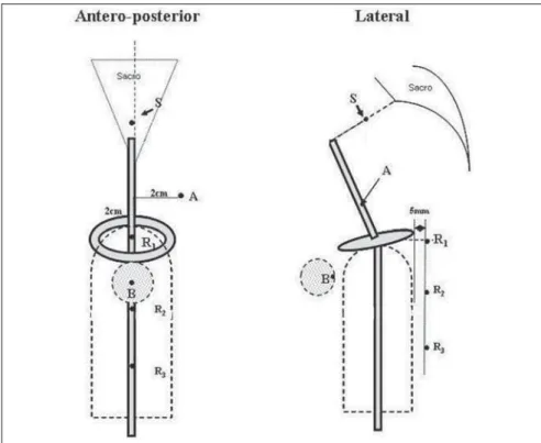 Figure 3. Simulation of isodoses obtained with intrauterine tandem and cylinder.