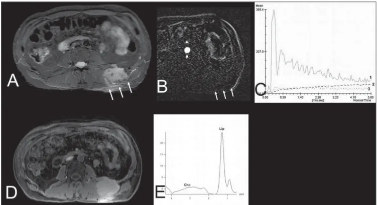 Figure 4. Case 42. Benign fibrous histiocytoma. A: Axial, STIR image showing expansile hyperintense ovoid, well defined lesion in the soft parts of the dorso- dorso-lumbar transition at left (arrows)