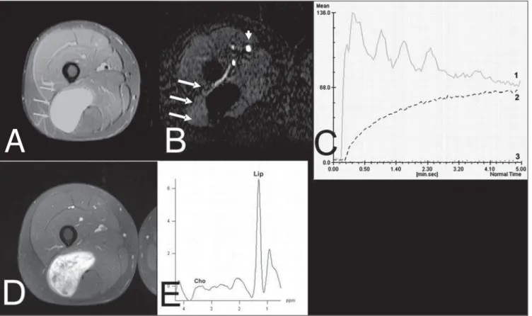 Figure 6. Case 4. Low-grade myxoid liposarcoma. A: Coronal, STIR sequence shows extensive, hyperintense, elongated, well defined lesion (arrows) in the posterior region of the right thigh