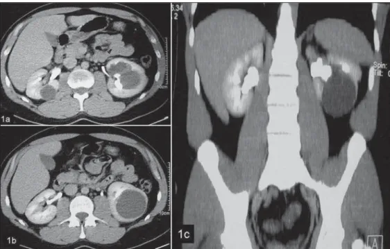 Figure 1. Contrast-enhanced CT image (pyelographic phase) in the axial plane (a,b) and coronal  recon-struction (c) demonstrating  para-pyelic and cortical cyst compressing and deforming the pericalyceal  sys-tem