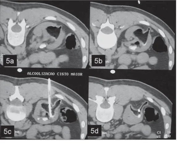 Figure 5. Ethanol is injected in an amount corresponding to about 25%–30% of the aspirate volume.