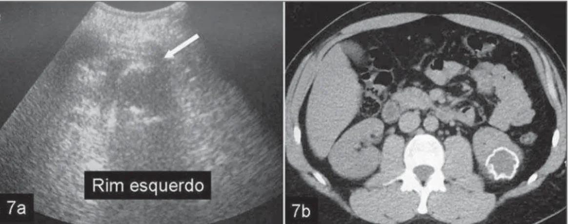 Figure 7. Post-procedural follow-up with US (a) and CT (b), performed six months after percutaneous sclerotherapy, demonstrates a significant reduction of the cyst (&gt; 50%) and calcification of walls