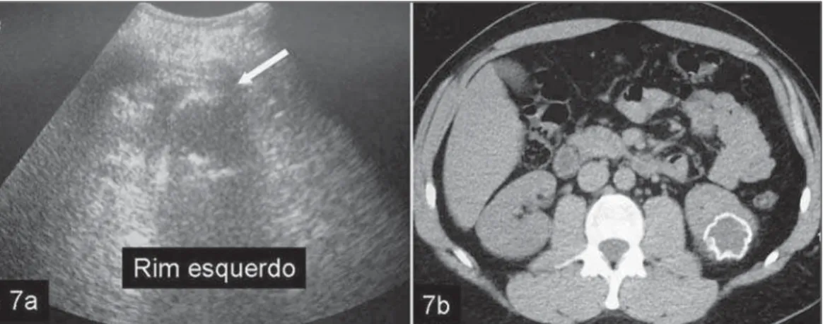 Figure 7. Post-procedural follow-up with US (a) and CT (b), performed six months after percutaneous sclerotherapy, demonstrates a significant reduction of the cyst (> 50%) and calcification of walls