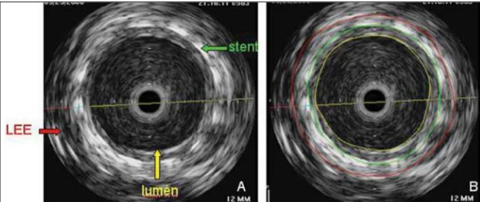 Figure 2. Cross section of the vessel and of the stent. A: Structures identification: LEE (external elastic layer), stent, lumen