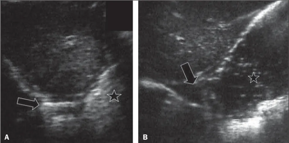 Figure 1. A: US image of intraabdominal esophagus at rest (arrow) and stomach filled with food (star).