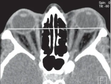 Figure 10. Sagittal  CT image demonstrating the measurement of the inferior rectus muscle and superior muscle complex.