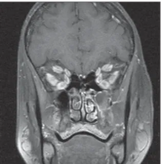 Figure 12. Sagittal CT image: note hypotrophy of the superior muscle com- com-plex with fat infiltration (arrow).