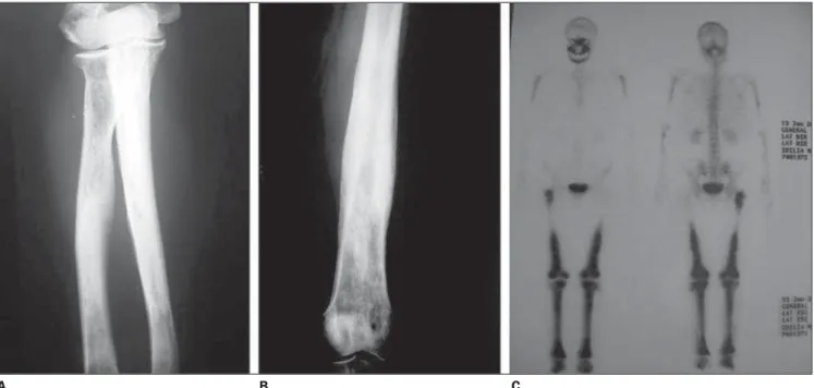 Figure 1. Radiography of forearm bones (A) and tibia (B) showing symmetrical osteosclerosis of long bones typical of Erdheim-Chester disease
