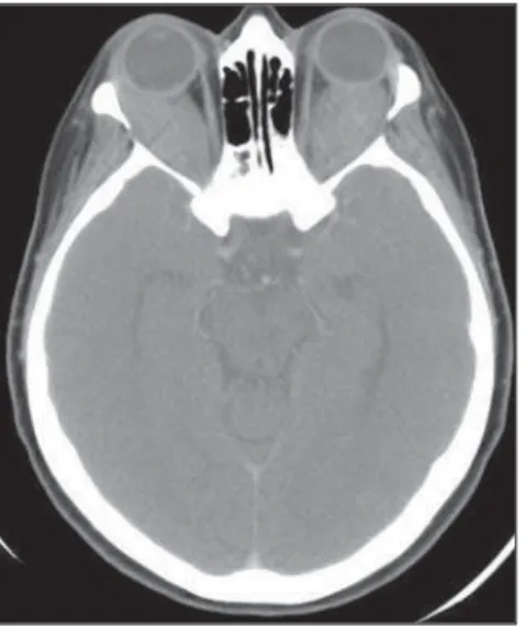 Figure 3. Contrast-enhanced computed tomography demonstrating bilateral, homogeneous perirenal infiltration