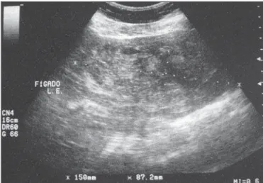 Figure 1. Upper abdomen ultrasonography demonstrating left hepatic lobe with increased volume, bulg- bulg-ing contour and diffusely heterogeneous echotexture.